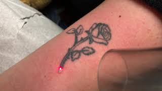 Laser tattoo removal on inner upper arm on a female at ExcelLase