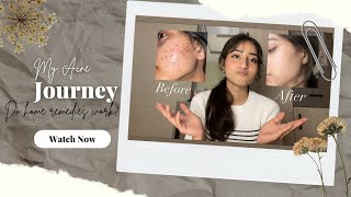 My Acne journey:) 👀  |Sampada Sigdel|