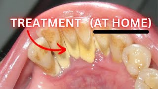 Gingivitis HOME Treatment? Did Your Dentist Lie To You!