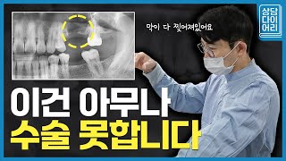 상악동막이 찢어진 이유? 뼈이식 임플란트로 개선 가능