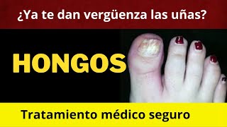 HONGOS EN LAS UÑAS DE LOS PIES (ONICOMICOSIS) TRATAMIENTO MÉDICO SEGURO