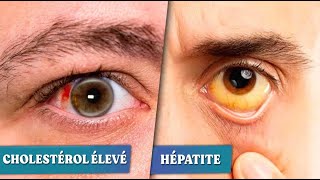 Yeux qui tremblent - 6 maladies que vos yeux peuvent révéler