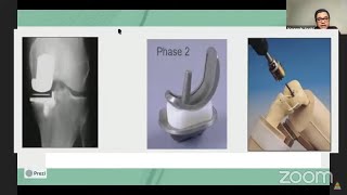 Unicondylar Knee Replacement: Step-by-Step