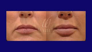 Lower Face Botox 101 Part 1 | Weiler Plastic Surgery Group