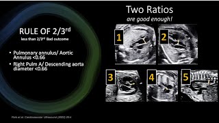 Assessment of Severity of TOF on Fetal Echo