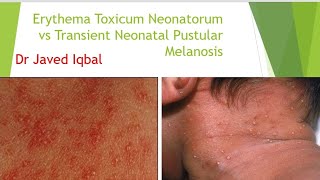 Erythema Toxicum Neonatorum VS Transient Neonatal Pustular Melanosis