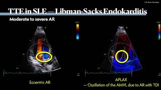 〖Echocardiography〗 Libman Sacks endocarditis🫀