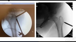 Endoscopy for Peritrochanteric Disorders