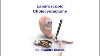 Gallbladder Removal Laparoscopic Cholecystectomy with Left Ventral Hernia and Mesh Placement