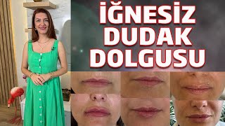 İğnesiz Dudak Dolgusu