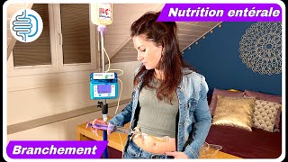 Branchement à domicile de la nutrition entérale sur sonde de gastrostomie (PEG)