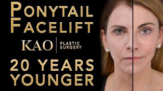 Extreme Makeover! Ponytail Facelift™ Progression - KAO Plastic Surgery Before and After