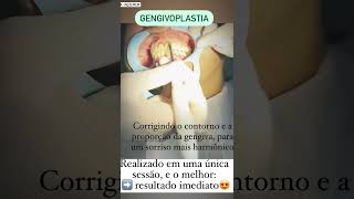 Gengivoplastia Londrina PR #gengivoplastialondrina  Yamar Odontologia