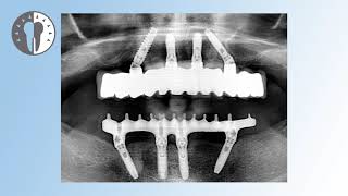 All on 4® Methode zur Implantatversorgung im Oberkiefer | Zahnarztpraxis Dr. med. dent. Mustafa Ayna