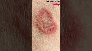 Ringworm tending resistant to drugs - science short