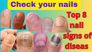 8 Nail Signs of health problems: Nutritional Deficiencies 💅to strongthen your nails