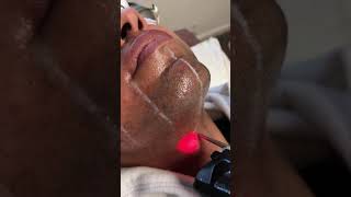 African American darker skin Transgender male going thru laser hair removal treatment on face