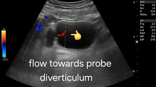 Diverticulum of urinary bladder, color Doppler ultrasound imaging, overview and management