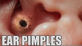 Ear Blackheads, Pimples in the Ear!