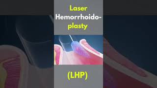 How to perform Hemorrhoids🤔 #hospital #medical #medicallife #hemorrhoids #mbbsstudent #shorts #fyp