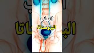 للرجال فقط _ التهاب البروستاتا وتأثيرها علي ضعف الإنتصاب #shorts