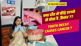 क्या दाँत में कीड़े लगने से होता है ,कैंसर ?? Is tooth decay causes CANCER..