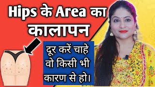 How to Remove Dark Acne spots n Dark Area of Butt(Hips)| Hips के Pimple के काले धब्बों का घरेलू इलाज