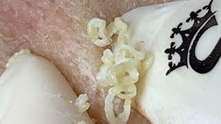 Big Cystic Acne Blackheads Extraction Blackheads & Milia, Whiteheads Removal Pimple Popping #PA264