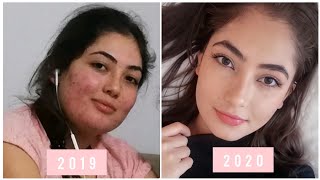 SİVİLCELERİMDEN NASIL KURTULDUM | Roaccutane tedavim - sivilce izlerim nasıl geçti? Fotoğraflı