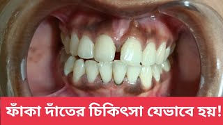 ১ মিনিটে ফাঁকা দাঁতের চিকিৎসা। Teeth Gap Close time lapse. Diastema close Treatment.