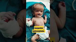 Congenital hydrocephalus #youtubeshorts #shorts #shortvideo