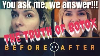 Η αλήθεια του BOTOX..  BEFORE AND AFTER VIDEO!!! + GIVEAWAY