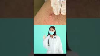 Dr.Nattacha, acne,blackheads.