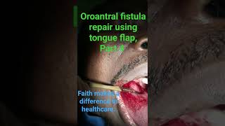 Oroantral fistula repair using anteriorly pedicled tongue flap (tongue flap harvesting) #havefaith