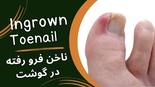 ناخن در گوشت فرورفته یا  ingrown toenail