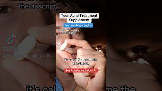 Teen boy acne treatment - Acnetame supplement #skincare