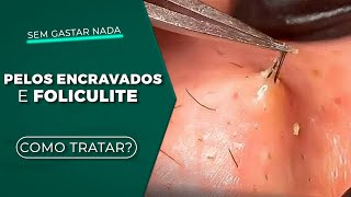 Como ACABAR com PELOS ENCRAVADOS e FOLICULITE sem gastar nada!