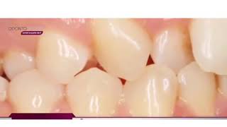 Por qué necesitas ponerte brackets? ODONTOCENTER