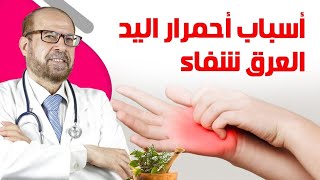 أسباب أحمرار😃 اليدالعرق شفاء😃