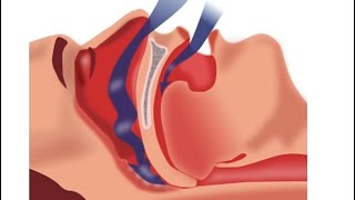 Obstructive sleep apnea #sleep