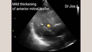 Mild AML or anterior mitral valve leaflet thickening, incidental finding, echo video