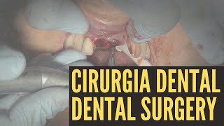 CIRURGIA DENTAL - COLOCAÇÃO DE IMPLANTE DENTAL - DENTAL SURGERY - DENTAL IMPLANT PLACEMENT