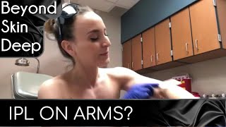 IPL TREATMENT ✨ Brown spots on Arms (Demo & Realtime Results)