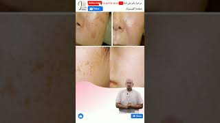 التغلب على البقع الداكنة في الوجه الدكتور عماد ميزاب Docteur Imad Mizab #short #shortvideo