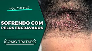 Você tem foliculite? Aprenda como tratar agora!