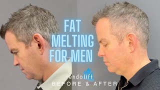 How to Get a Defined Jawline: Male Double Chin Removal with Endolift by Dr Nina Bal