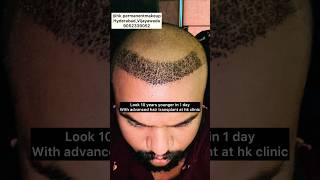 #hairtransplant at #hkpermanentmakeup hyderabad Vijayawada 9052339052 9000002422 #permanentsolution