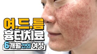 여드름흉터원정대 17탄. 여드름흉터 6개월간의 치료과정 그리고 2번째 사이클 시작