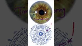 Seen Through the Lens of Iridology - Tonsillectomy