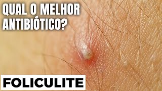 QUAL O MELHOR ANTIBIÓTICO PARA A FOLICULITE [DICA DA ESPECIALISTA]